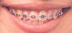 Bangkok Dental Clinic Braces