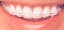 Thailand Dental Clinic Braces