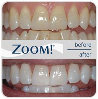 zoom teeth whitening before and after